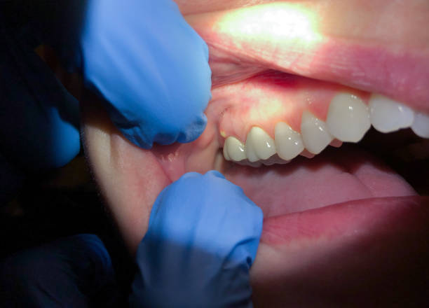 Best Dentist for Tooth Abscess  in Glen Rock, PA
